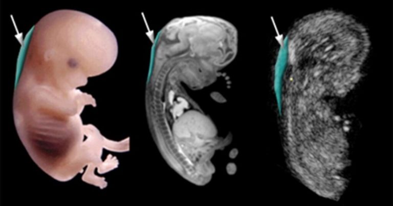 Nuchal Translucency￼