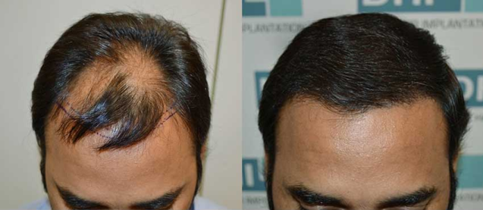 Hair transplant cost in India