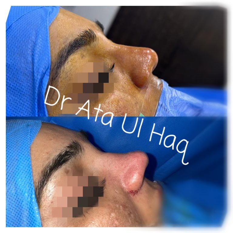 Rhinoplasty in Lahore |How to Get in Touch with a Nose Job