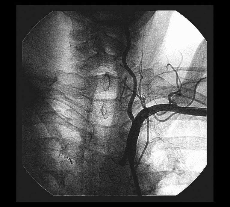 Embolizations Albuquerque