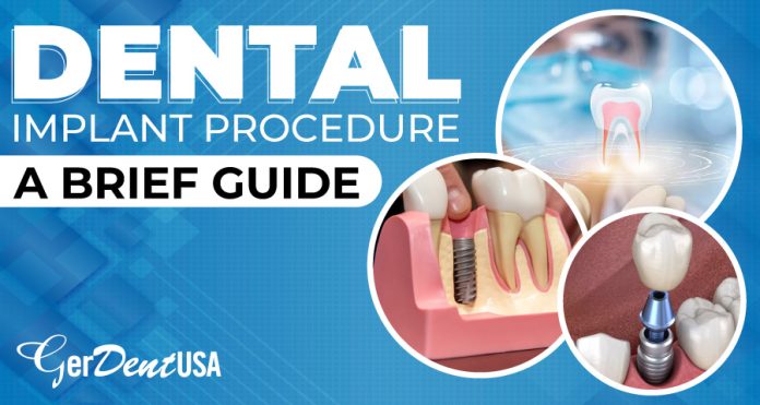 dental implant procedure