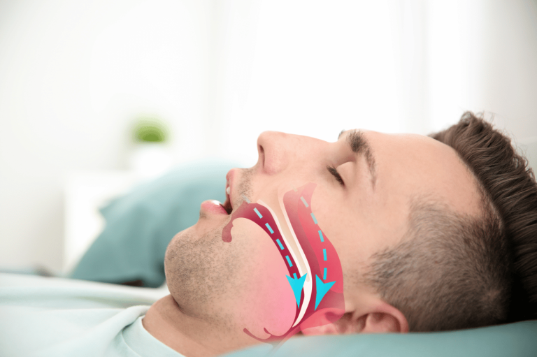 <strong>Reasons Why You Need to Use Dental Devices to Treat Sleep Apnea</strong>