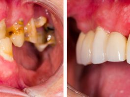 Gingival Depigmentation