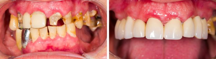 Gingival Depigmentation
