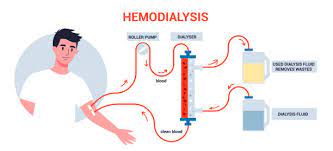 hemodialysis access