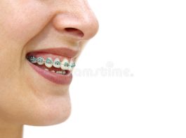 metal partial denture