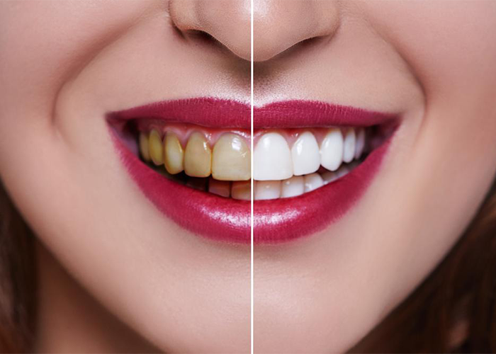 natural teeth whitening