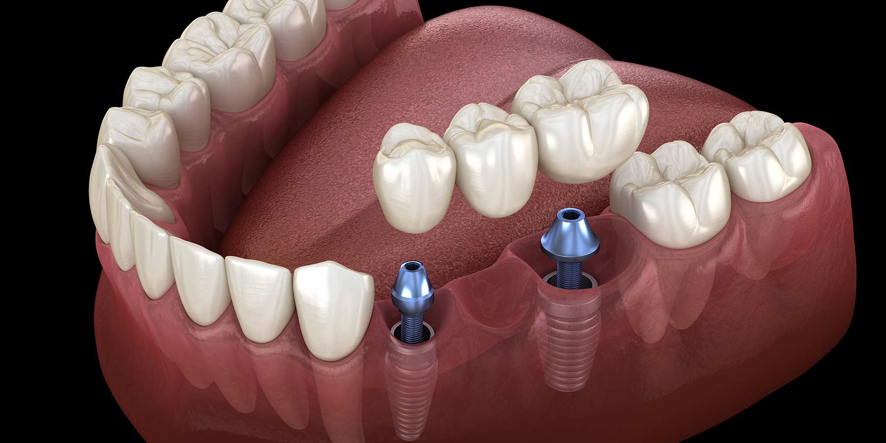 dental implants bridges