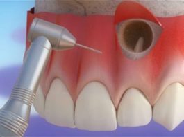 endodontic surgery in Houston, 77079