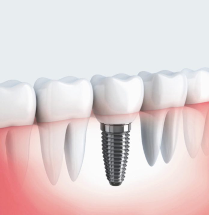 dental implant Liverpool