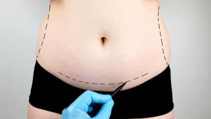 Live with your full potential with a tummy tuck