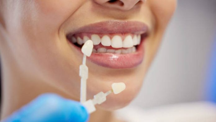 What You Need To Know About Dental Veneers