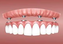 affordable dentures and implants