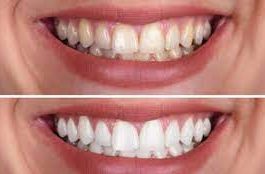 teeth whitening near me