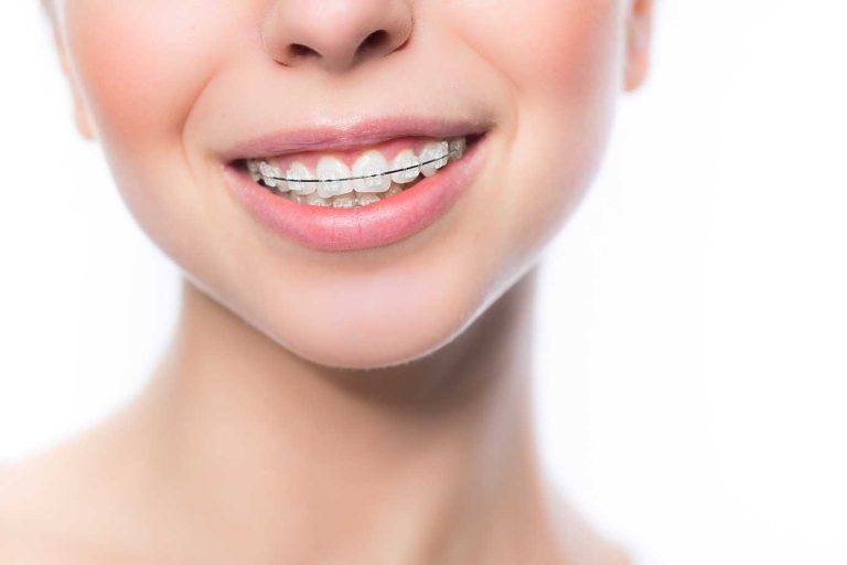 Exploring Menifee Orthodontics: Comprehensive Guide to Braces and Aligners
