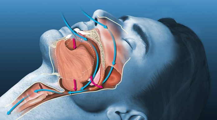 sleep apnoea