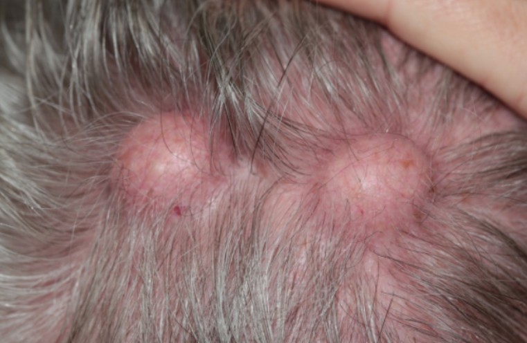 Best Wrinkle and Juvederm Treatments in Irvine, CA