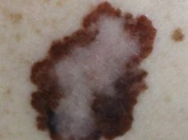 dermatologist Orange CA