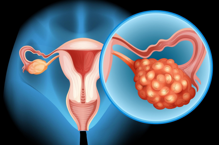 ovarian cancer treatment