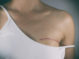 Breast Cancer