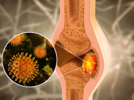 Bone Cancer